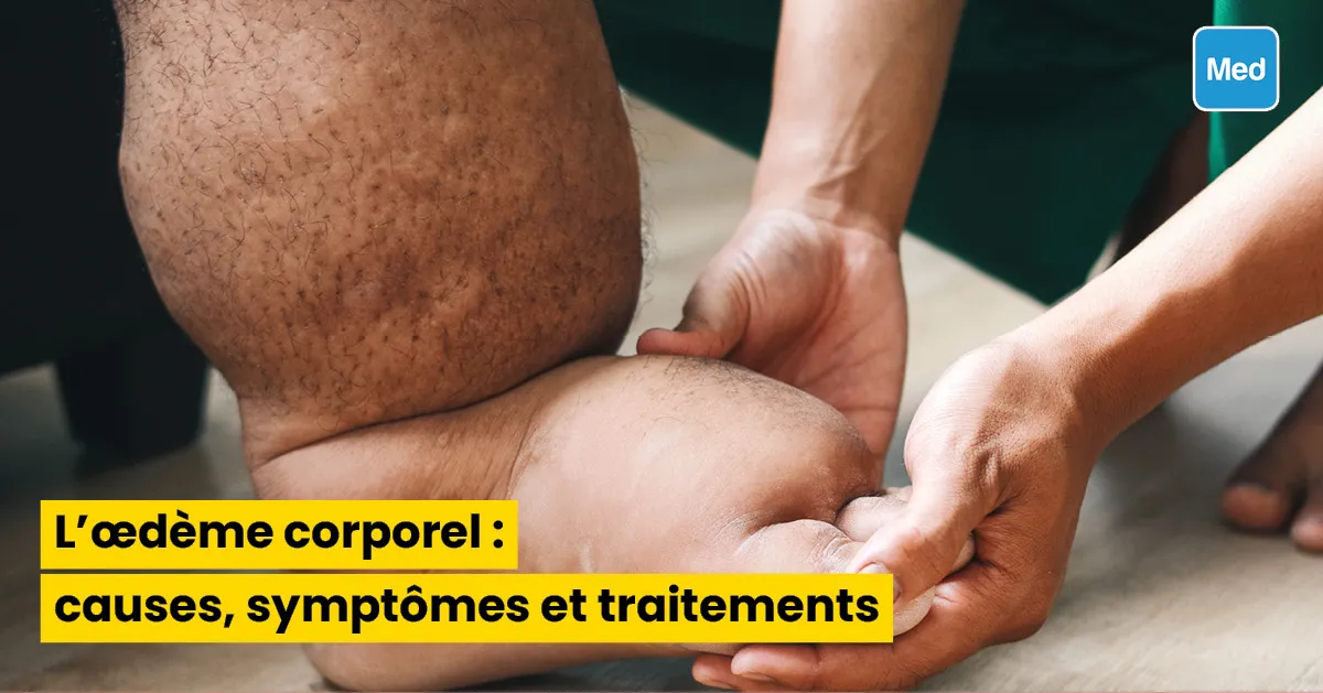  L’œdème corporel : causes, symptômes et traitements 